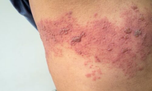 เตือนภัย “งูสวัด” โรคใกล้ตัวที่ปวดรุนแรงกว่าที่คิด